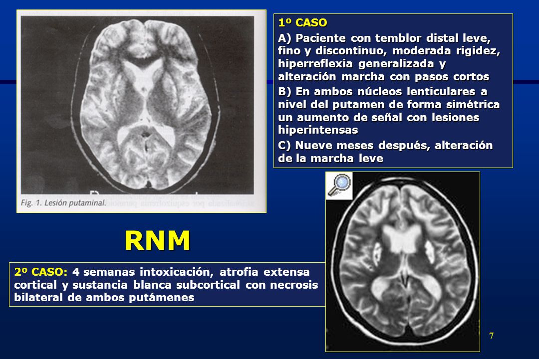 1º CASO A) Paciente con temblor distal leve, fino y discontinuo, moderada rigidez, hiperreflexia generalizada y alteración marcha con pasos cortos.