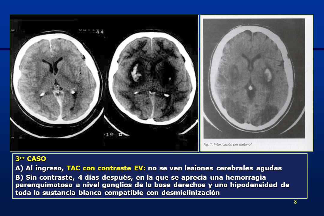3er CASO A) Al ingreso, TAC con contraste EV: no se ven lesiones cerebrales agudas.