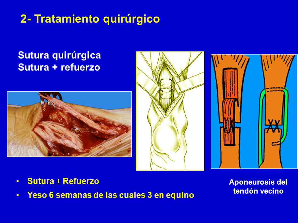 Sutura quirúrgica Sutura + refuerzo