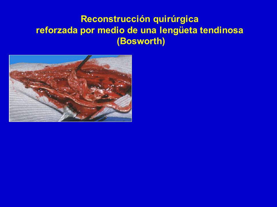 Reconstrucción quirúrgica reforzada por medio de una lengüeta tendinosa (Bosworth)