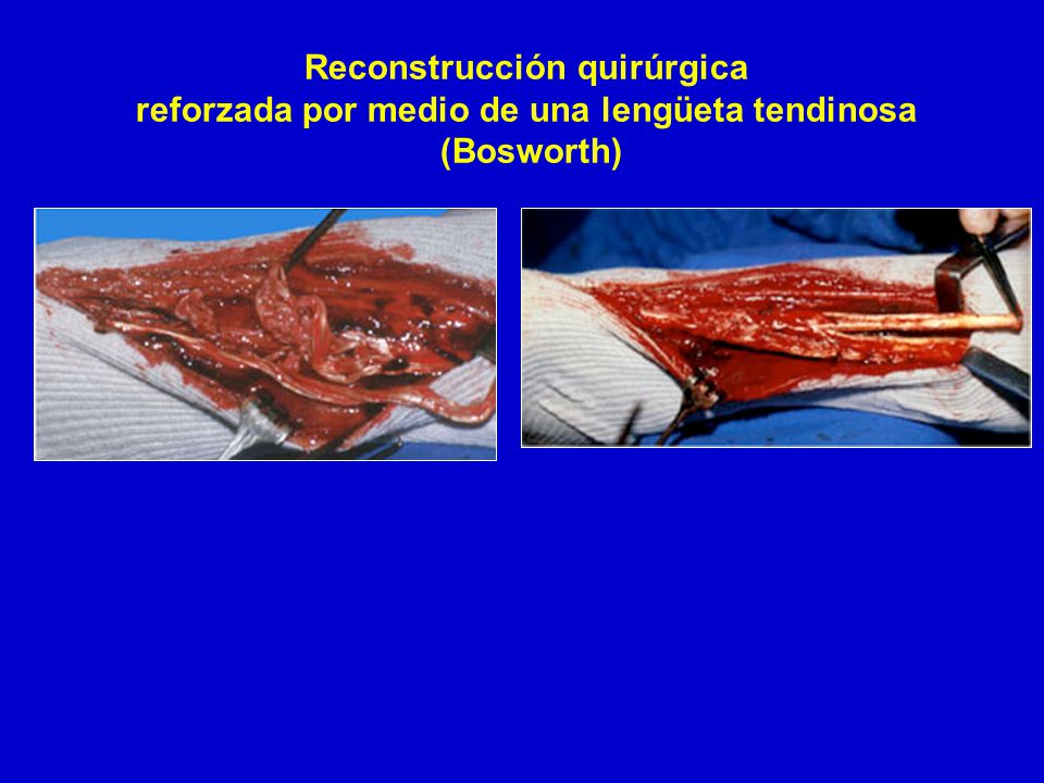 Reconstrucción quirúrgica reforzada por medio de una lengüeta tendinosa (Bosworth)