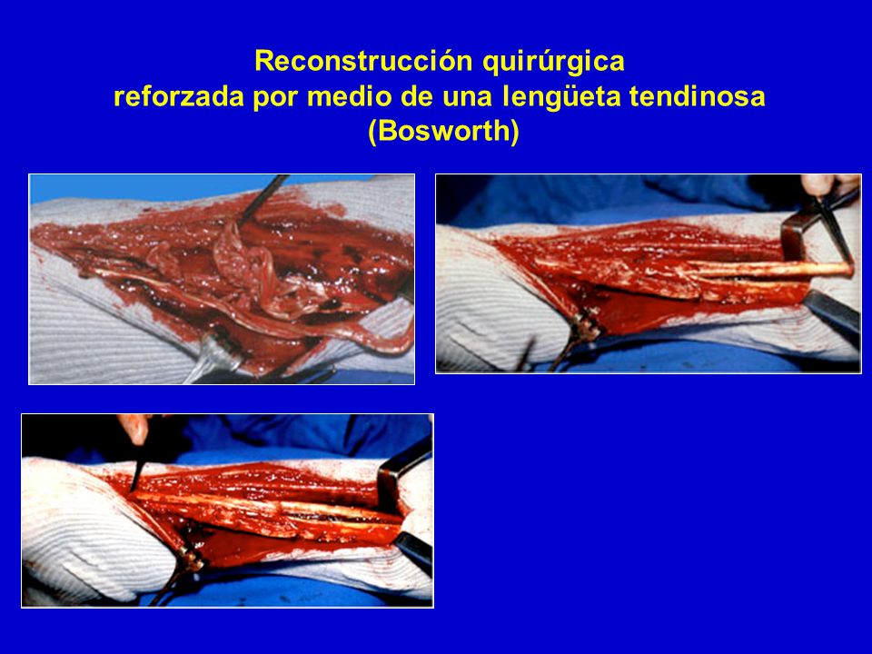 Reconstrucción quirúrgica reforzada por medio de una lengüeta tendinosa (Bosworth)