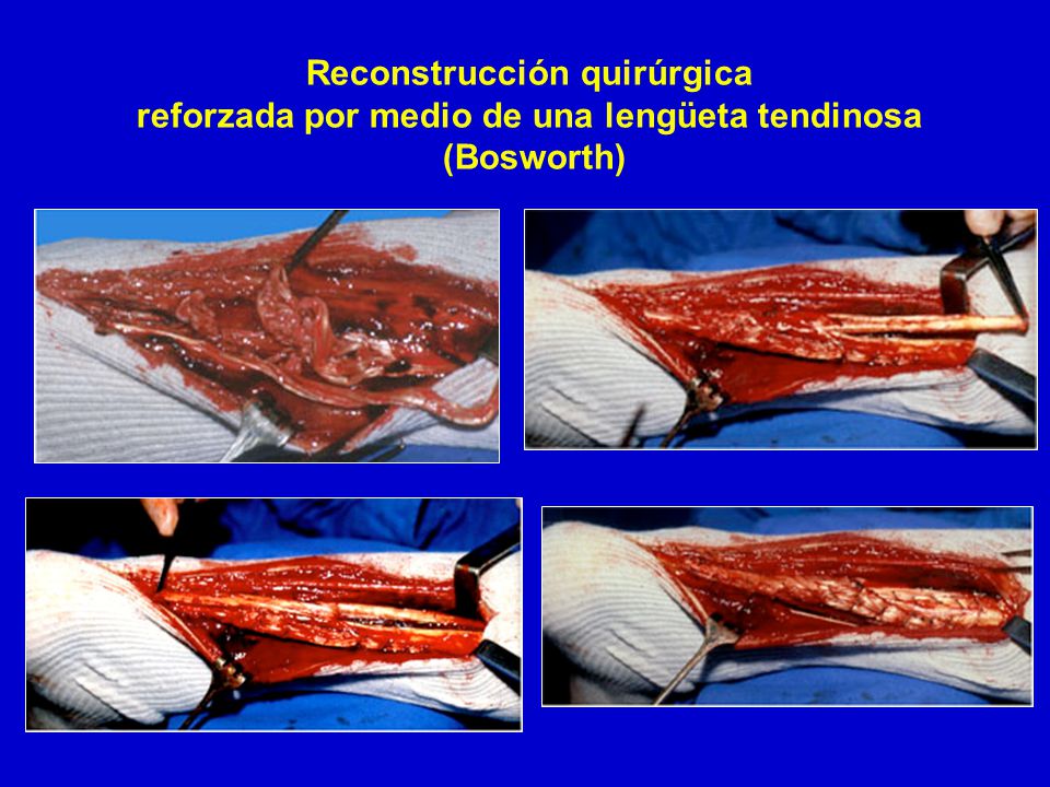 Reconstrucción quirúrgica reforzada por medio de una lengüeta tendinosa (Bosworth)