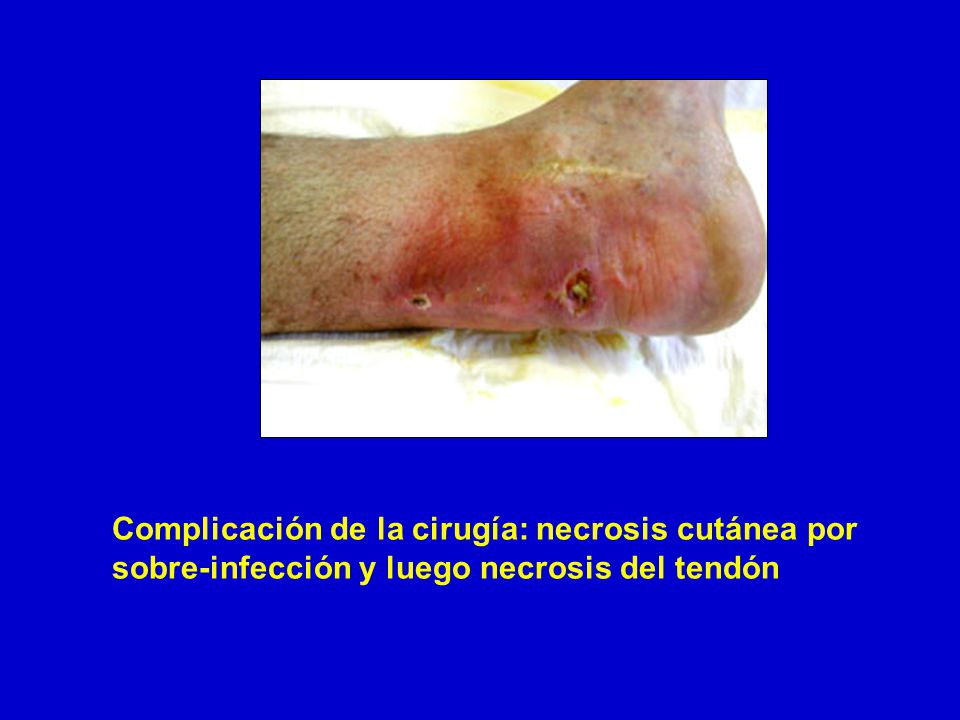 Complicación de la cirugía: necrosis cutánea por sobre-infección y luego necrosis del tendón