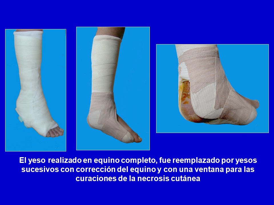 El yeso realizado en equino completo, fue reemplazado por yesos sucesivos con corrección del equino y con una ventana para las curaciones de la necrosis cutánea