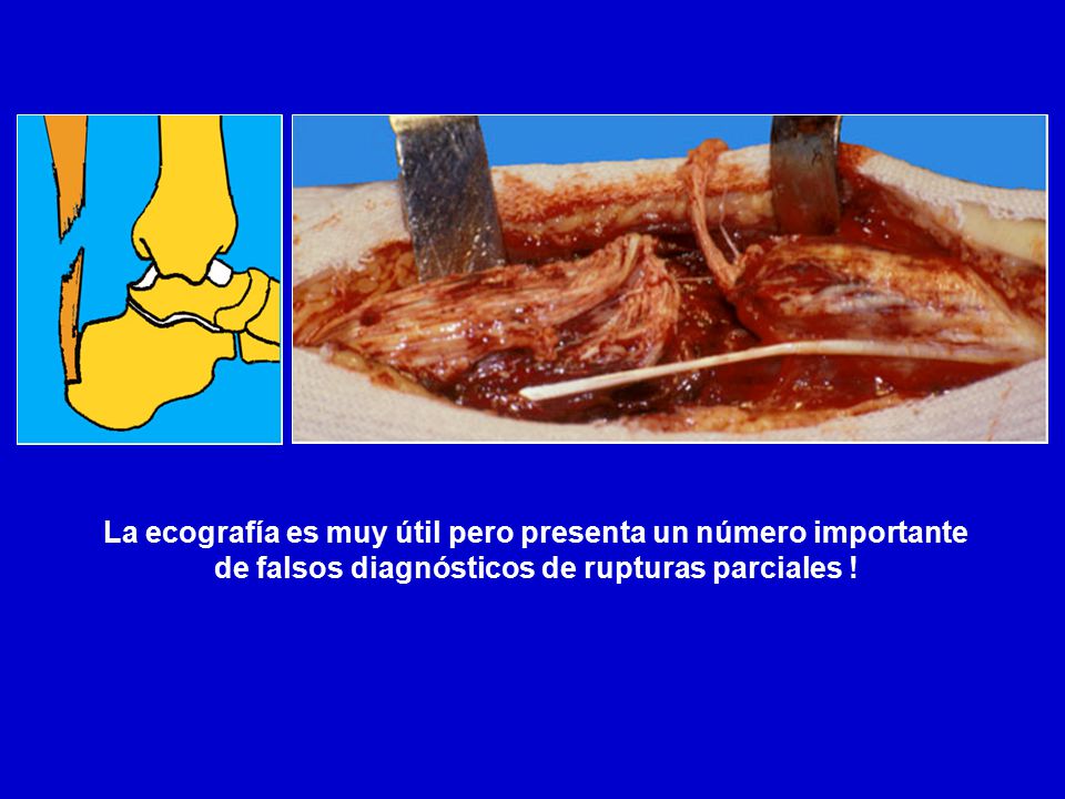 La ecografía es muy útil pero presenta un número importante de falsos diagnósticos de rupturas parciales !