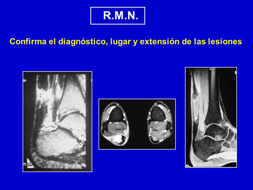 R.M.N. Confirma el diagnóstico, lugar y extensión de las lesiones