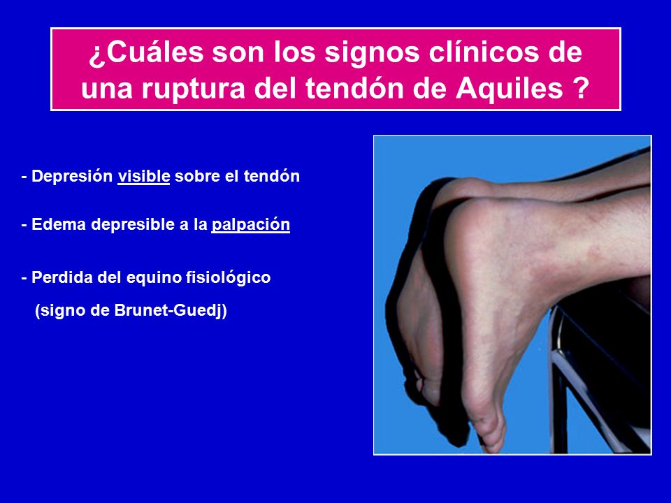 ¿Cuáles son los signos clínicos de una ruptura del tendón de Aquiles