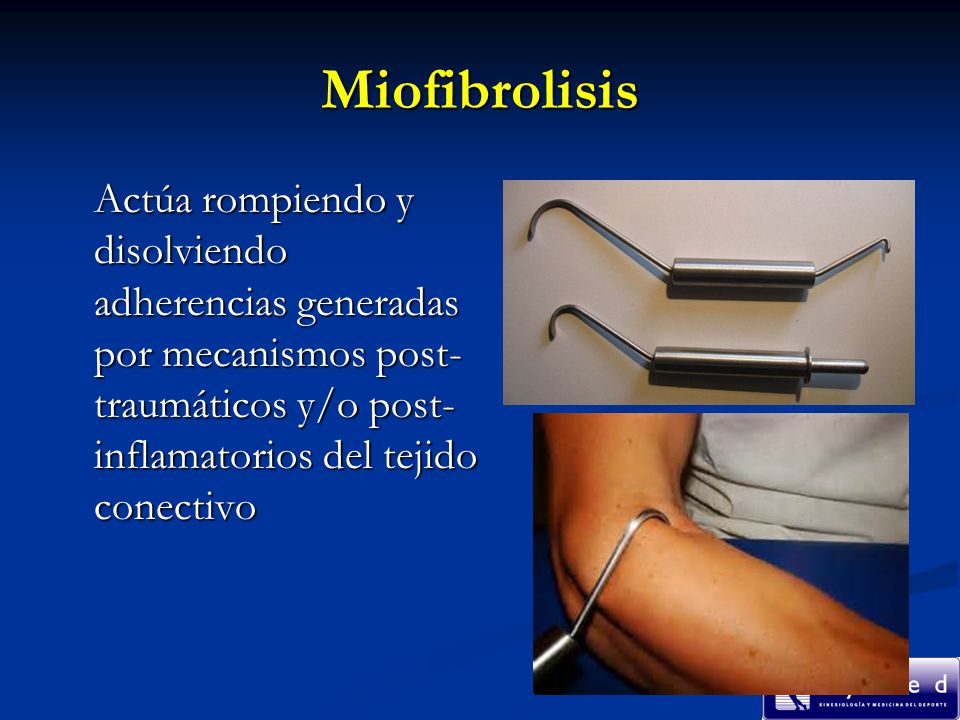 Miofibrolisis Actúa rompiendo y disolviendo adherencias generadas por mecanismos post-traumáticos y/o post-inflamatorios del tejido conectivo.