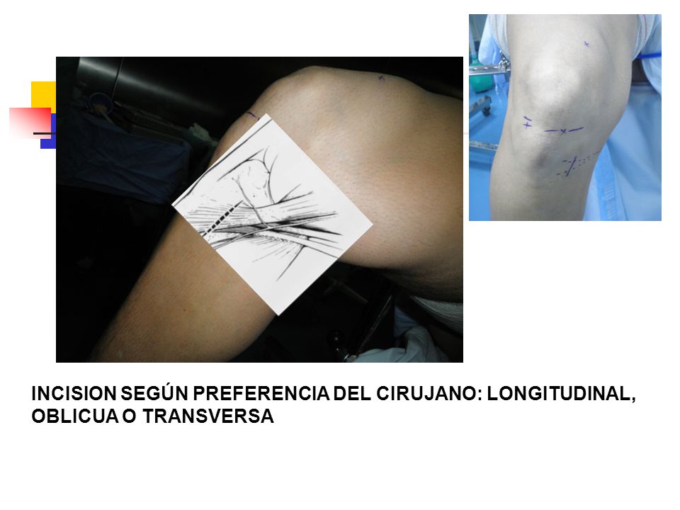 INCISION SEGÚN PREFERENCIA DEL CIRUJANO: LONGITUDINAL,