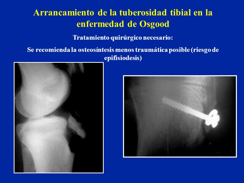 Arrancamiento de la tuberosidad tibial en la enfermedad de Osgood