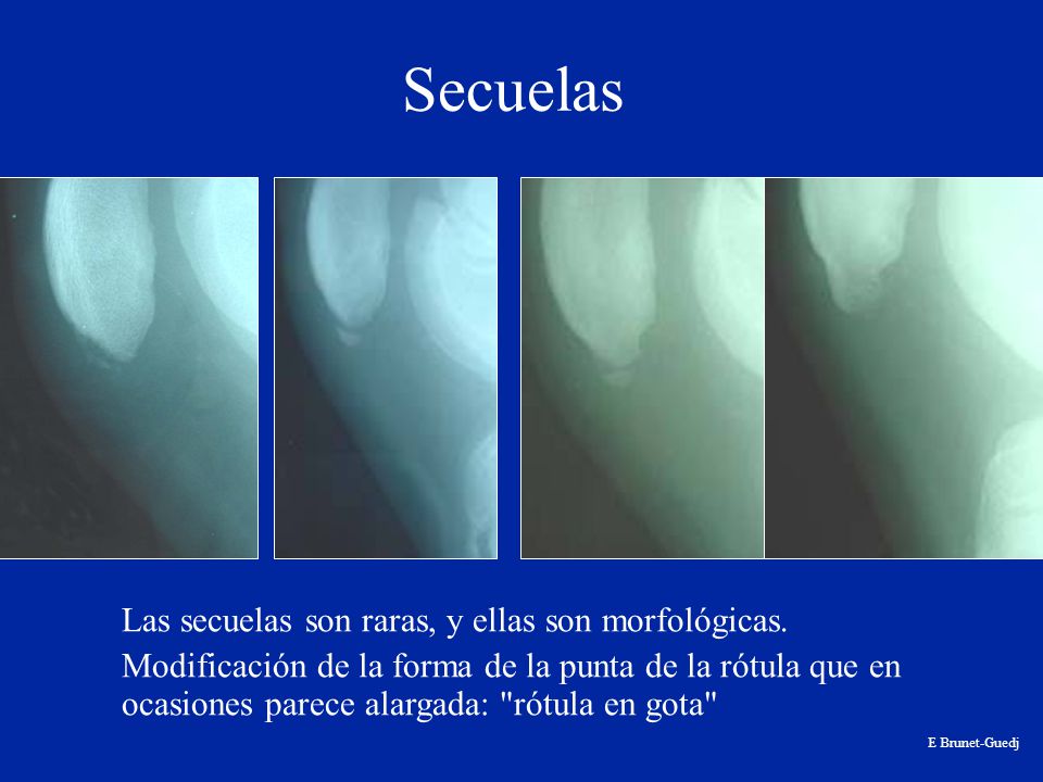 Secuelas Las secuelas son raras, y ellas son morfológicas.