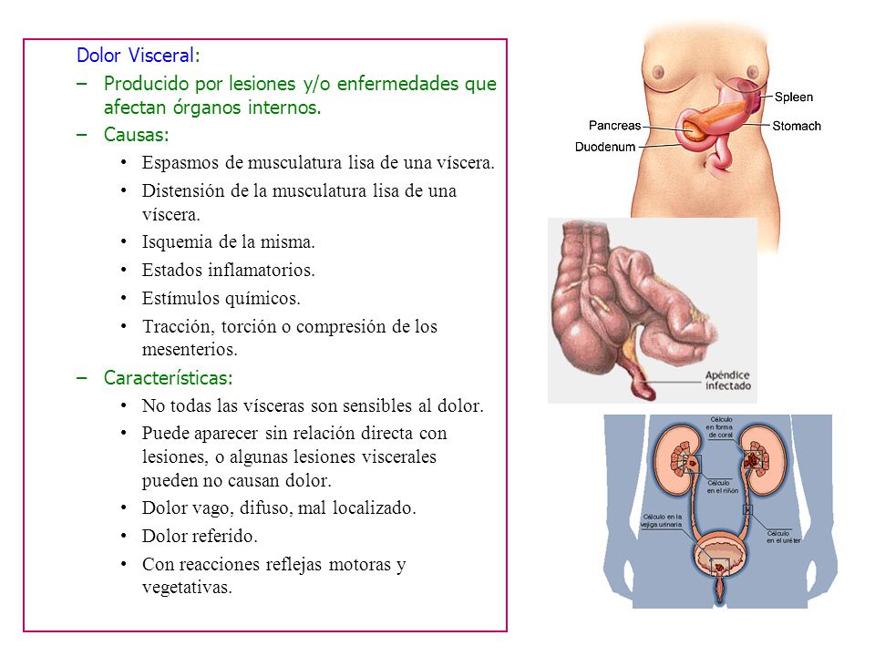 Dolor Referido: dolor percibido en una parte del cuerpo alejada del sitio donde se origina.