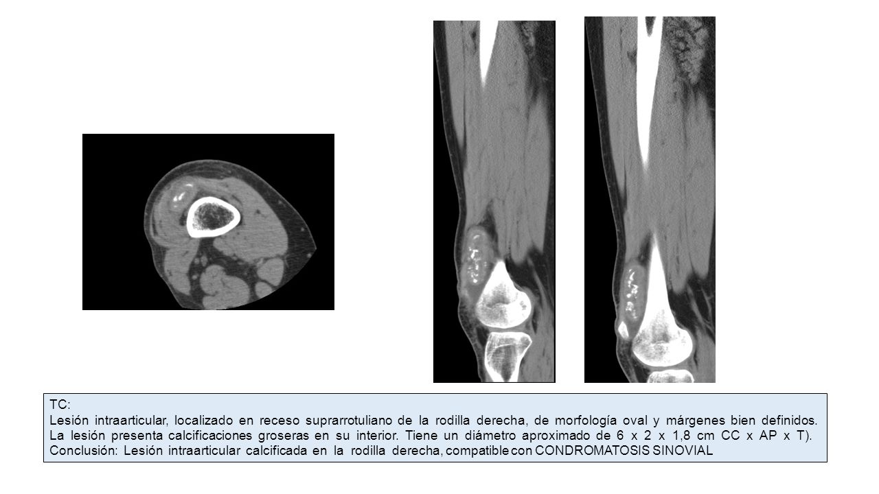 TC: Lesión intraarticular, localizado en receso suprarrotuliano de la rodilla derecha, de morfología oval y márgenes bien definidos.