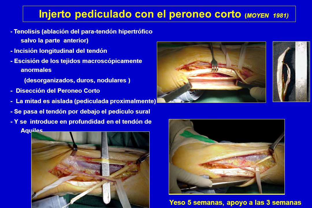 Injerto pediculado con el peroneo corto (MOYEN 1981)