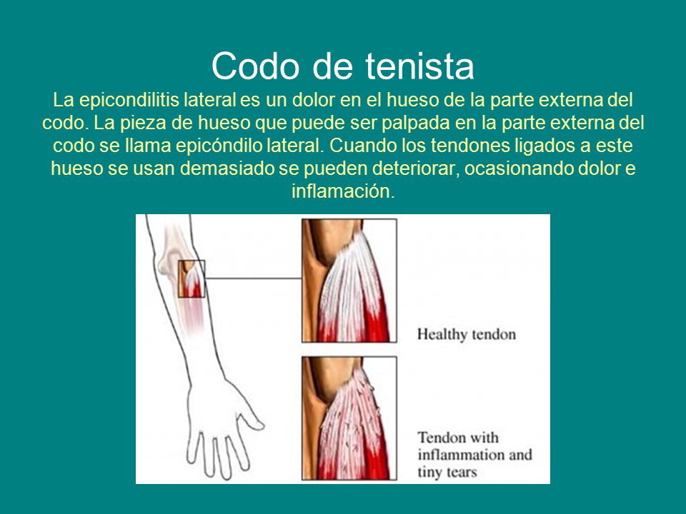 Codo de tenista La epicondilitis lateral es un dolor en el hueso de la parte externa del codo.