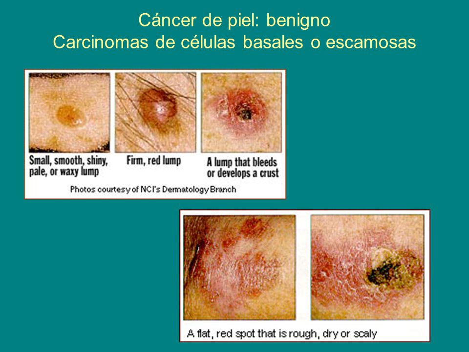 Cáncer de piel: benigno Carcinomas de células basales o escamosas