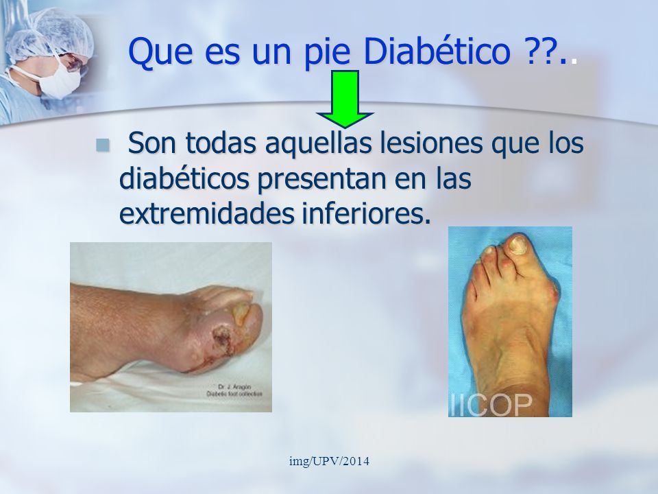 Que es un pie Diabético .. Son todas aquellas lesiones que los diabéticos presentan en las extremidades inferiores.