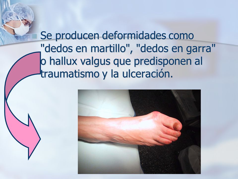 Se producen deformidades como dedos en martillo , dedos en garra o hallux valgus que predisponen al traumatismo y la ulceración.