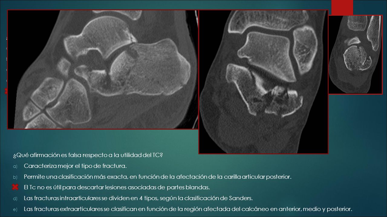 ¿ En cuanto a la fractura de calcáneo, cual de las siguientes afirmaciones es incorrecta
