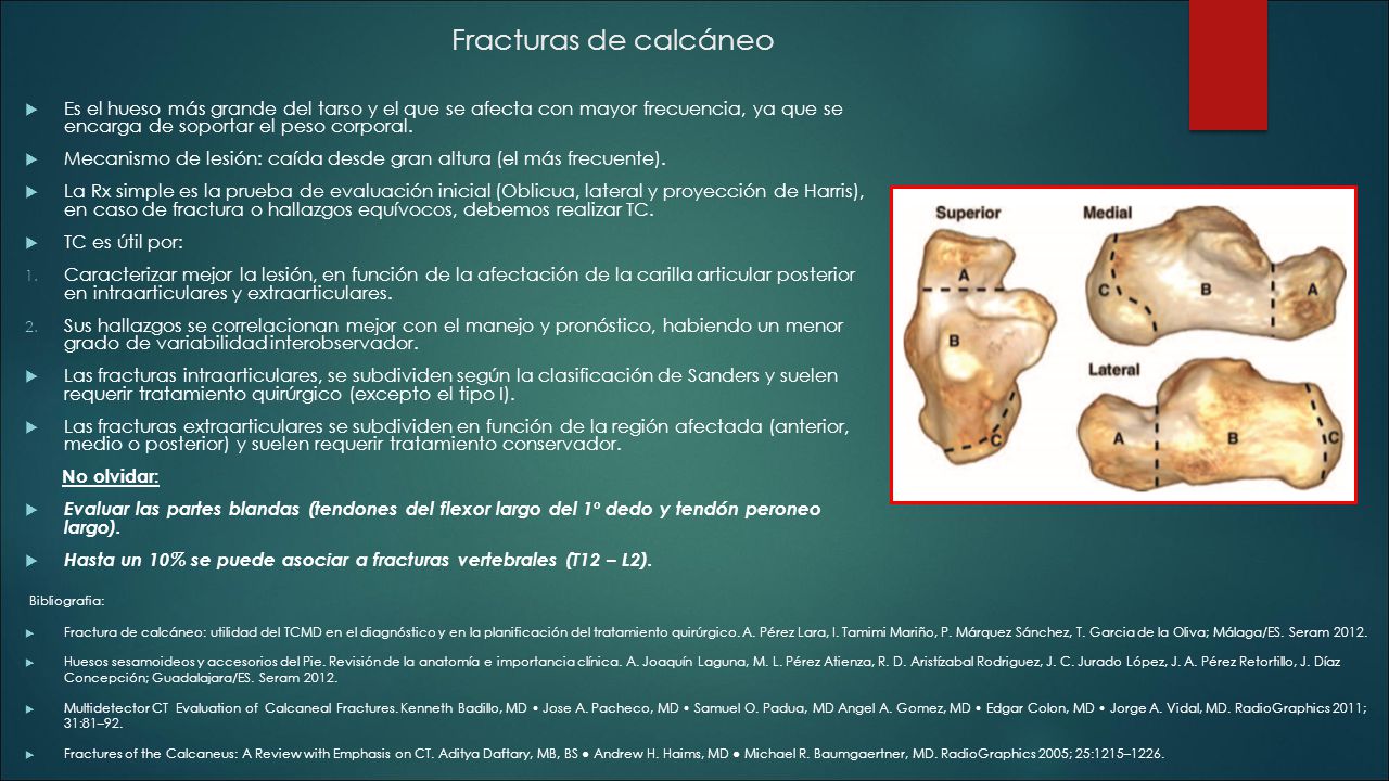 Fracturas de calcáneo Es el hueso más grande del tarso y el que se afecta con mayor frecuencia, ya que se encarga de soportar el peso corporal.