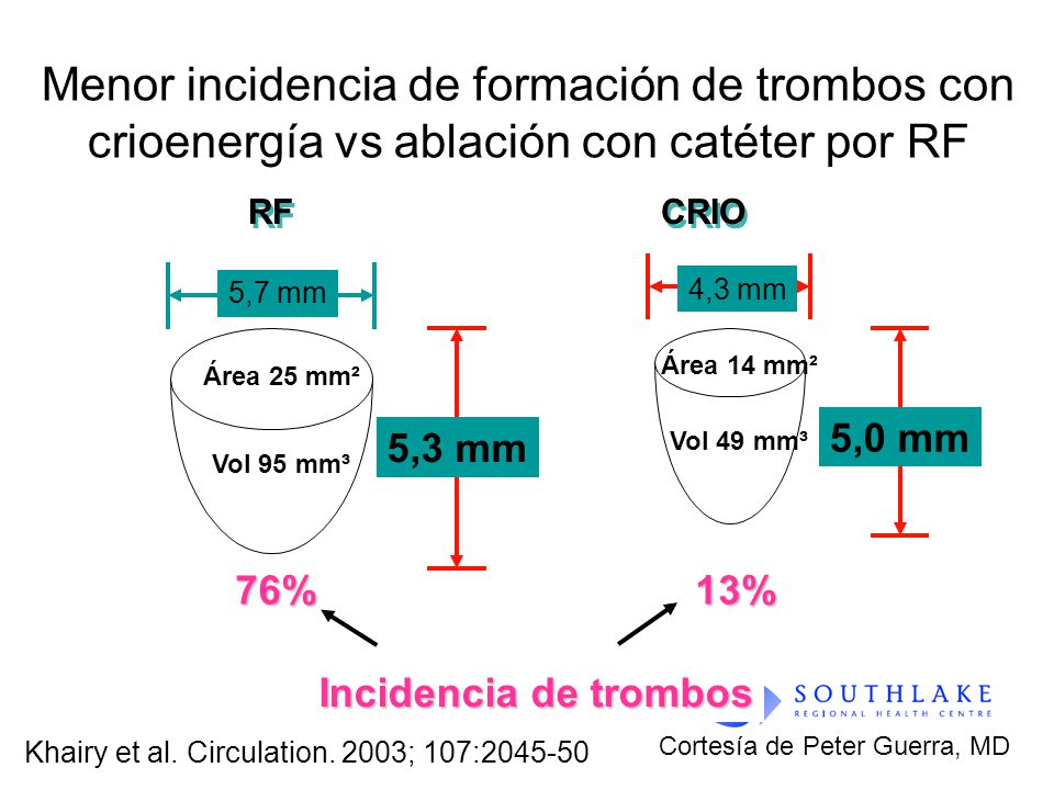 Menor incidencia de formación de trombos con crioenergía vs ablación con catéter por RF