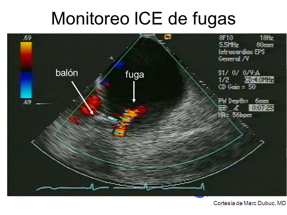 Monitoreo ICE de fugas balón fuga Cortesía de Marc Dubuc, MD 22
