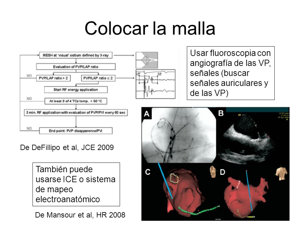 Colocar la malla Usar fluoroscopia con angiografía de las VP, señales (buscar señales auriculares y de las VP)