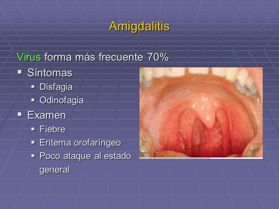 Amigdalitis Virus forma más frecuente 70% Síntomas Examen Disfagia