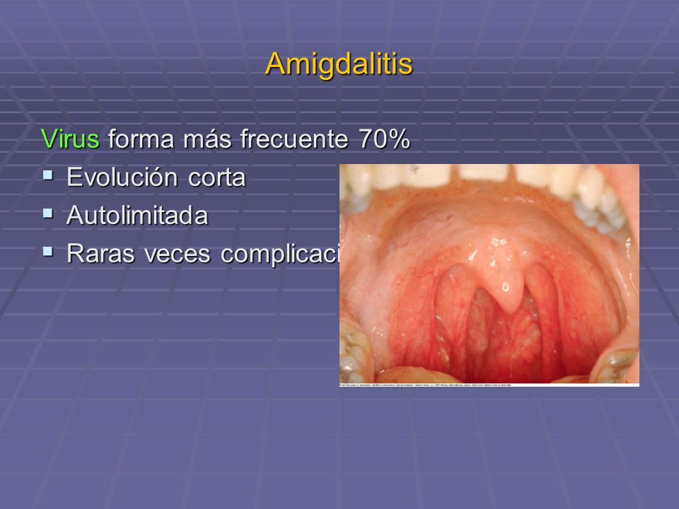 Amigdalitis Virus forma más frecuente 70% Evolución corta Autolimitada