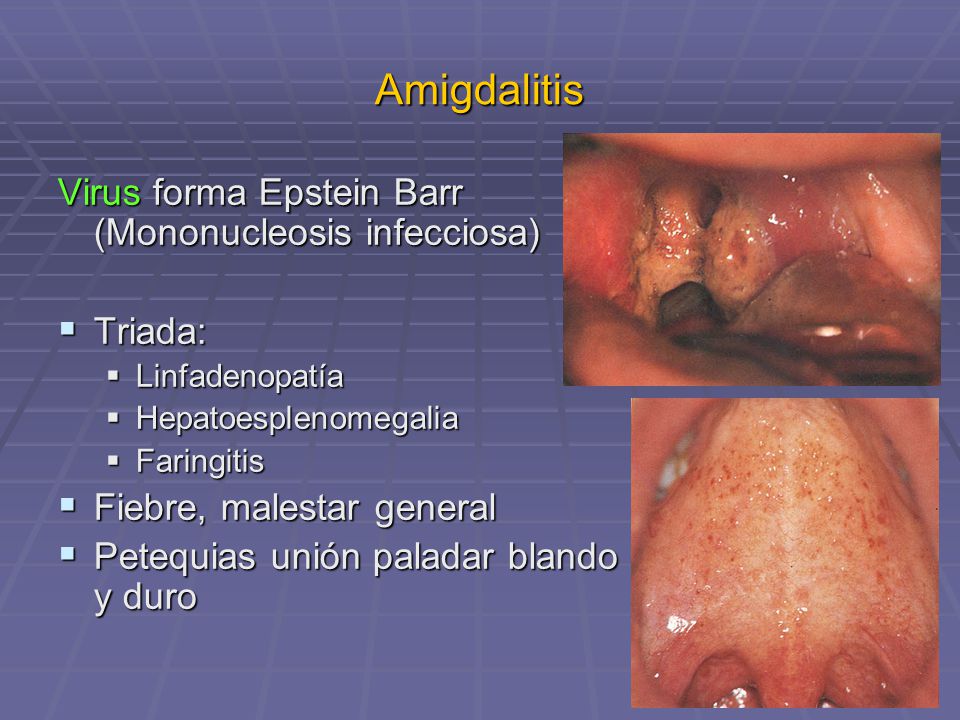 Amigdalitis Virus forma Epstein Barr (Mononucleosis infecciosa)