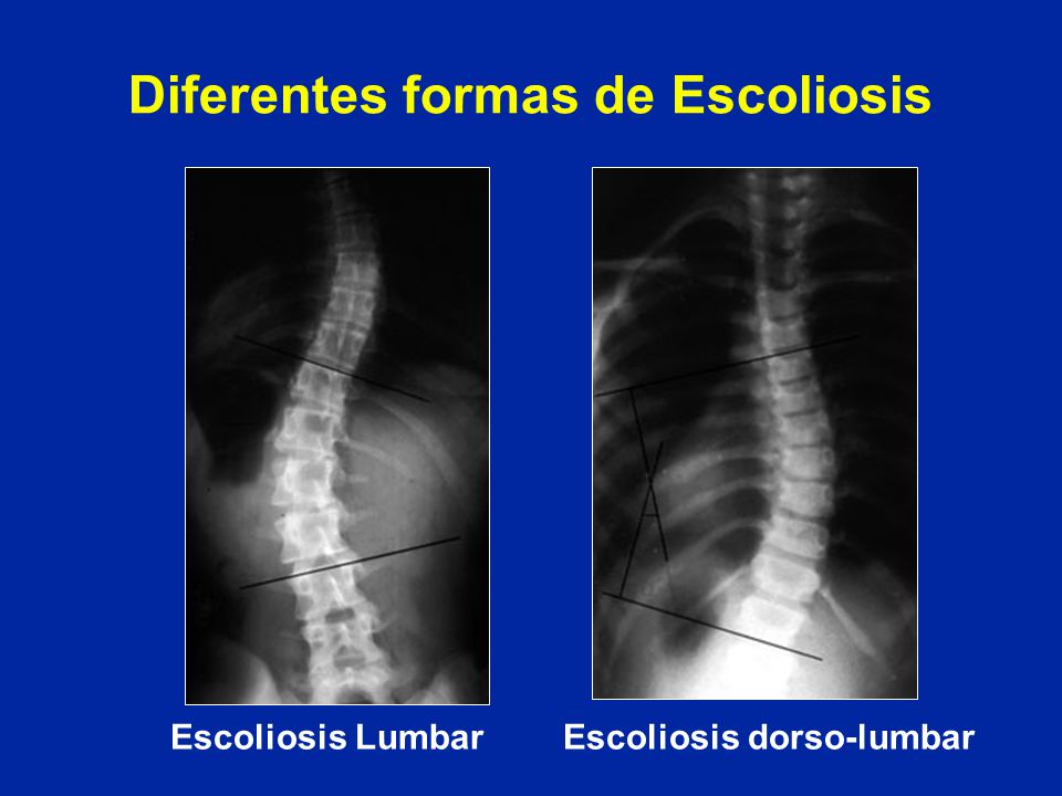 Diferentes formas de Escoliosis