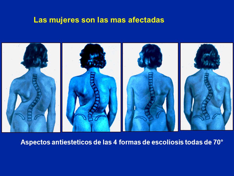 Aspectos antiesteticos de las 4 formas de escoliosis todas de 70°