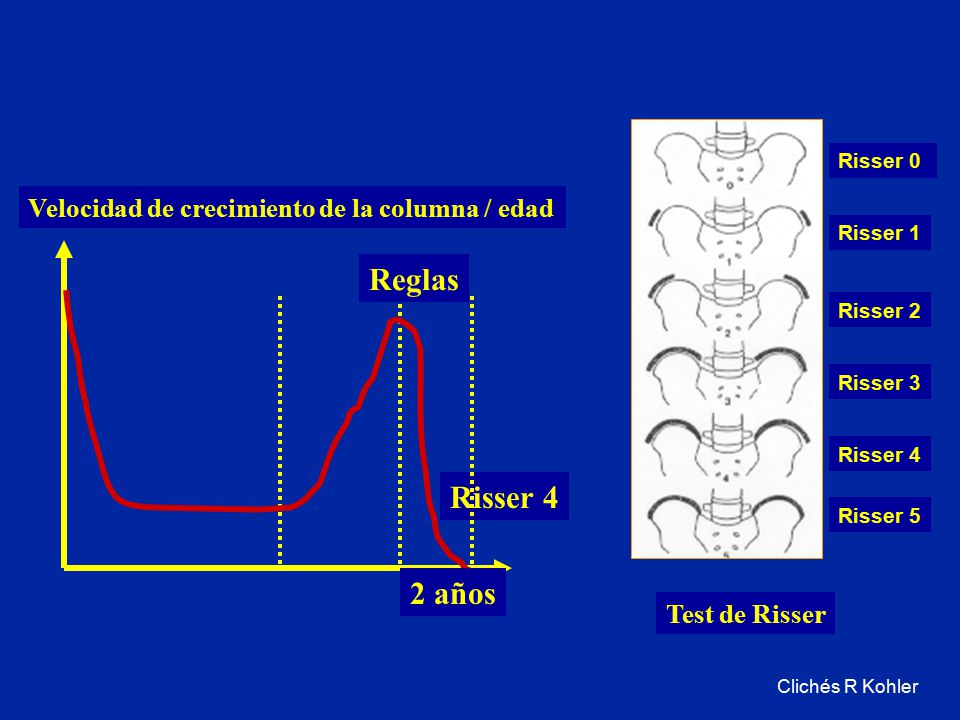 Reglas Risser 4 2 años Velocidad de crecimiento de la columna / edad