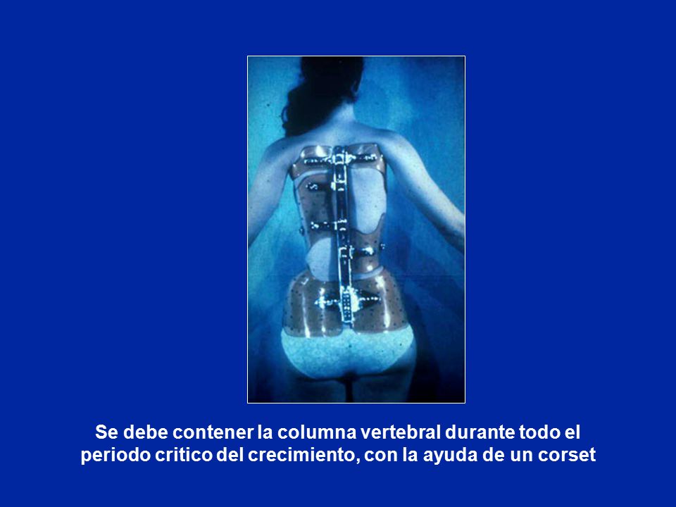 Se debe contener la columna vertebral durante todo el periodo critico del crecimiento, con la ayuda de un corset