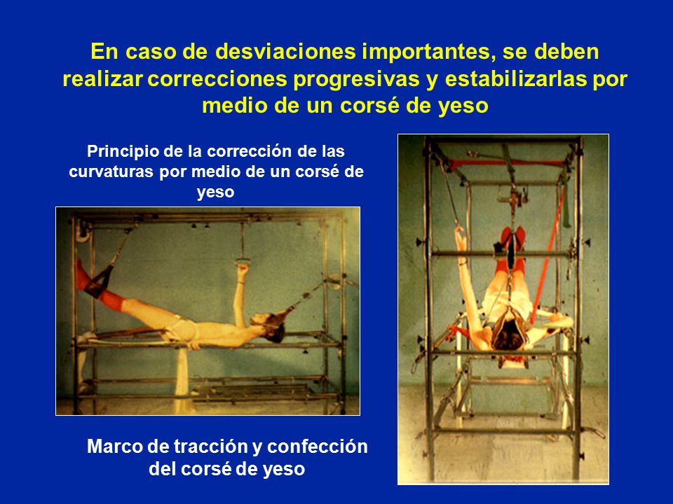 Marco de tracción y confección del corsé de yeso