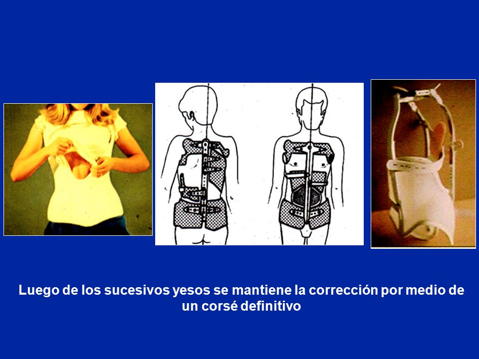 Luego de los sucesivos yesos se mantiene la corrección por medio de un corsé definitivo