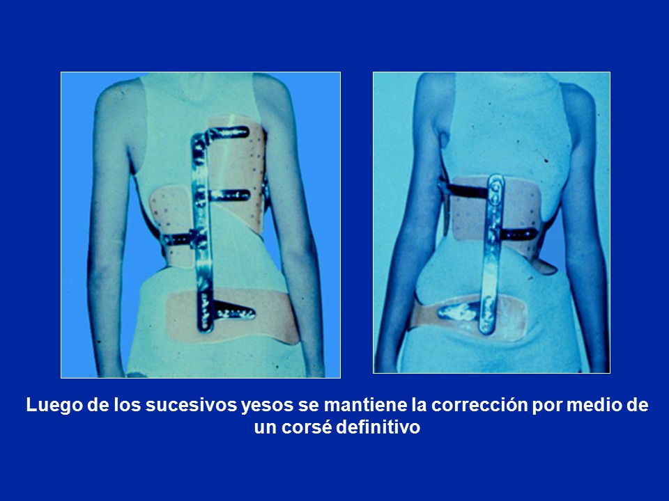 Luego de los sucesivos yesos se mantiene la corrección por medio de un corsé definitivo