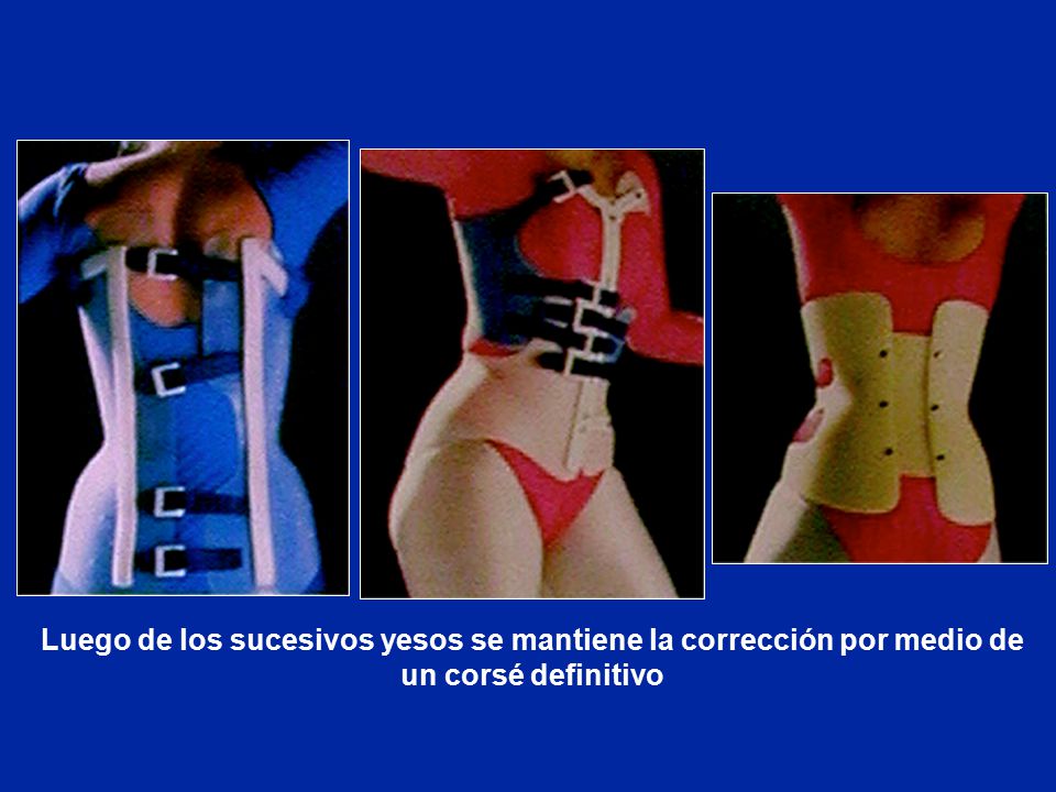 Luego de los sucesivos yesos se mantiene la corrección por medio de un corsé definitivo