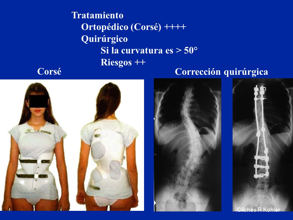 Ortopédico (Corsé) ++++ Quirúrgico Si la curvatura es > 50°