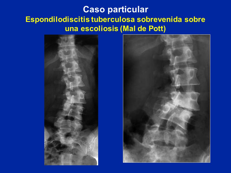 Caso particular Espondilodiscitis tuberculosa sobrevenida sobre una escoliosis (Mal de Pott)