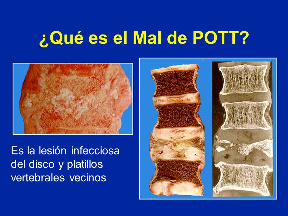 ¿Qué es el Mal de POTT Es la lesión infecciosa del disco y platillos vertebrales vecinos