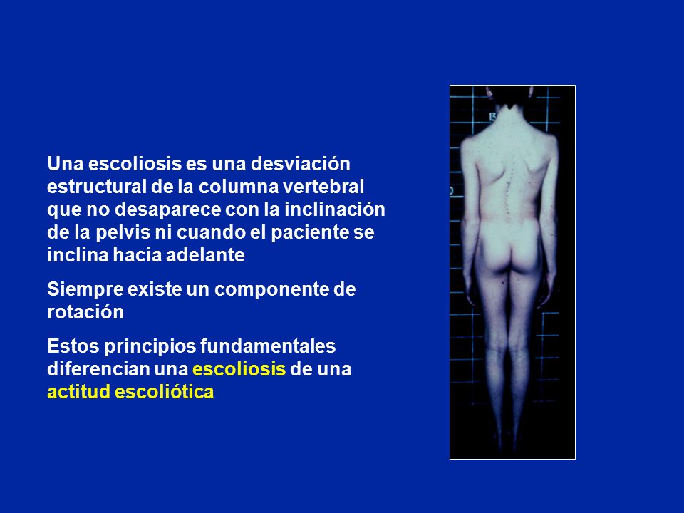 Una escoliosis es una desviación estructural de la columna vertebral que no desaparece con la inclinación de la pelvis ni cuando el paciente se inclina hacia adelante