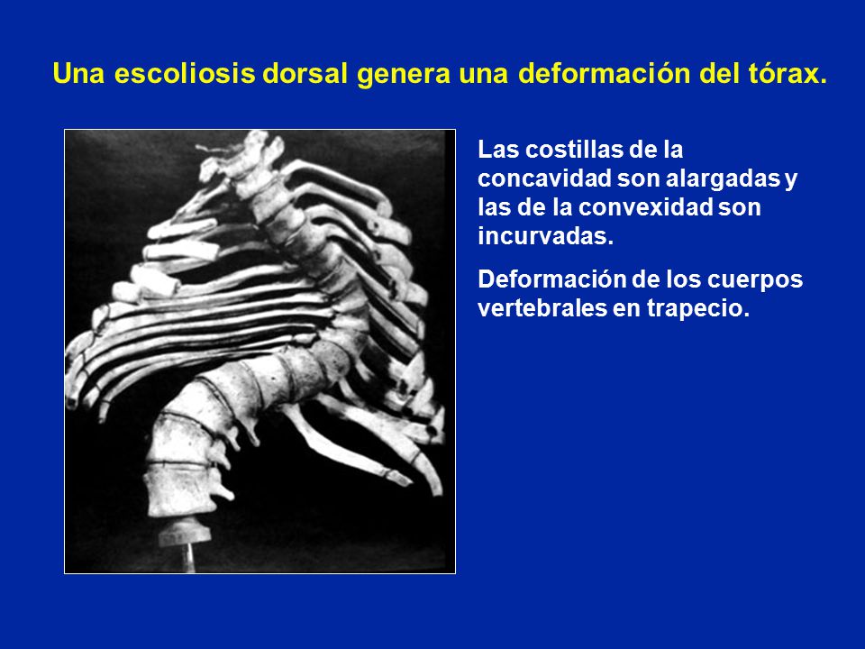Una escoliosis dorsal genera una deformación del tórax.