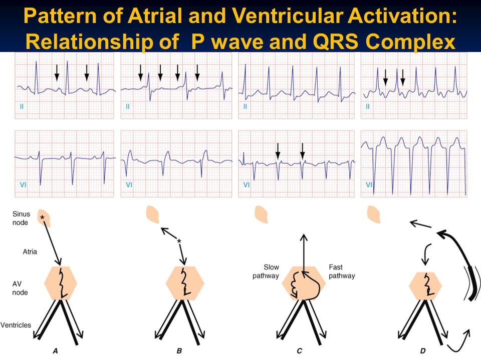Pattern of Atrial and Ventricular Activation: Relationship of P wave and QRS Complex