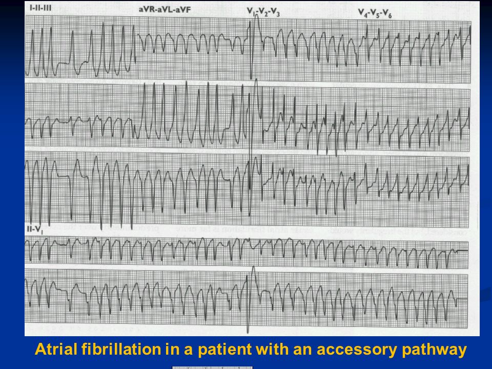 Atrial fibrillation in a patient with an accessory pathway
