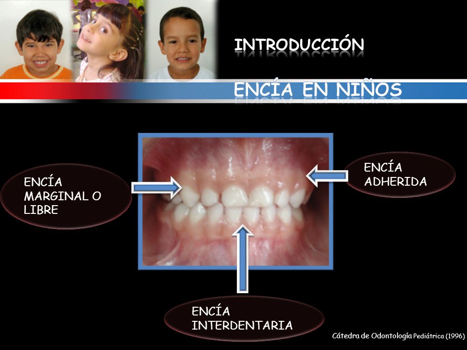 ENCÍA EN NIÑOS INTRODUCCIÓN ENCÍA ADHERIDA ENCÍA MARGINAL O LIBRE