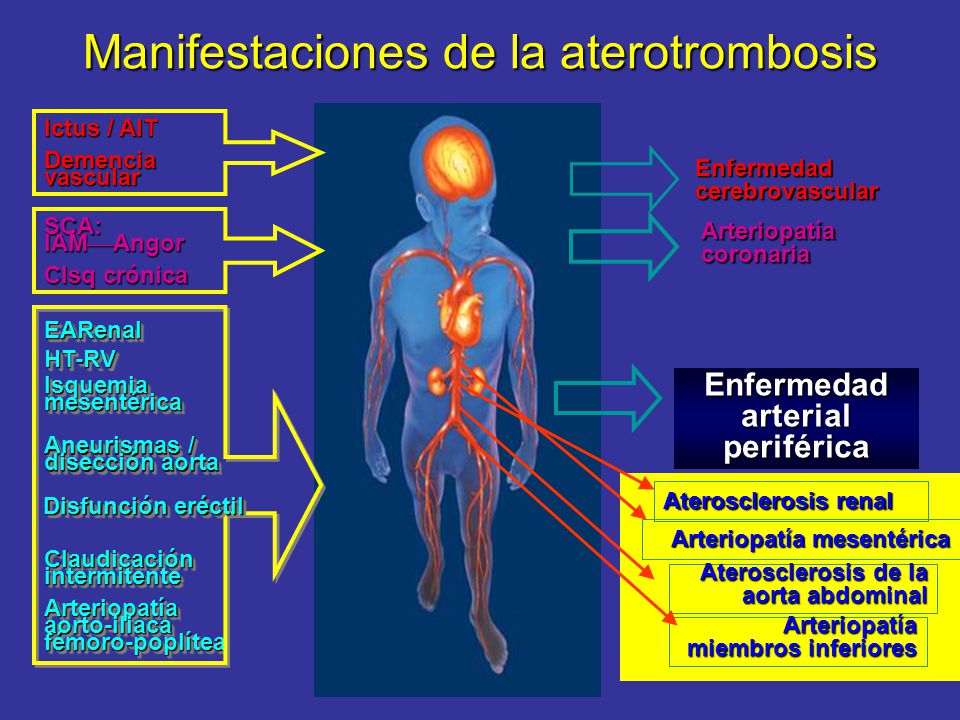 causas de la enfermedad de las arterias coronarias