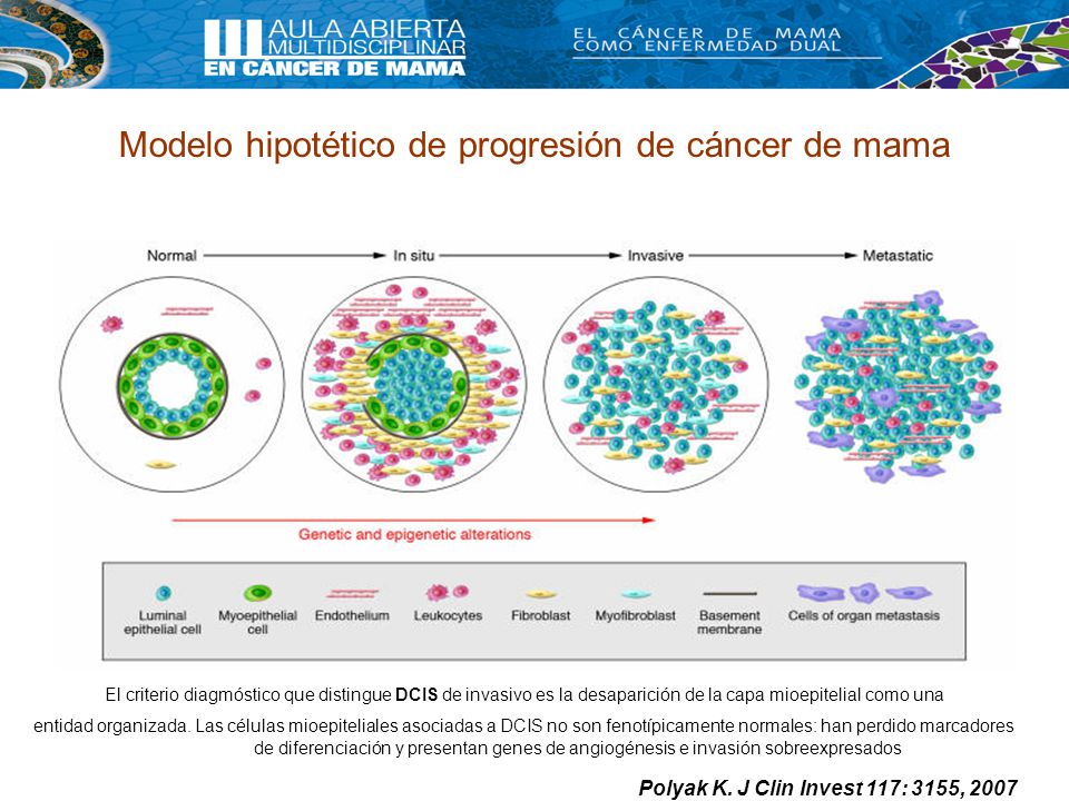 Modelo hipotético de progresión de cáncer de mama