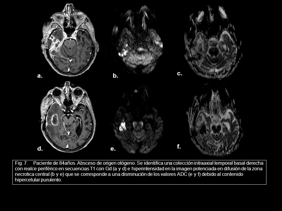 c. a. b. f. d. e. Fig. 7. Paciente de 84años. Absceso de origen otógeno. Se identifica una colección intraaxial temporal basal derecha.